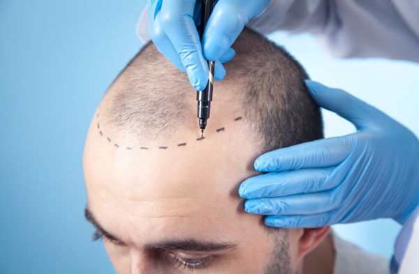 Haartransplantation - Haarkontor